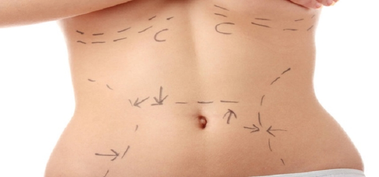 Closeup photo of a caucasian woman's abdomen marked with lines for abdominal cosmetic surgery